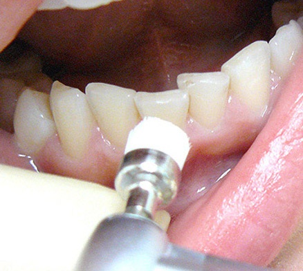 Лечение желтого налета на зубах