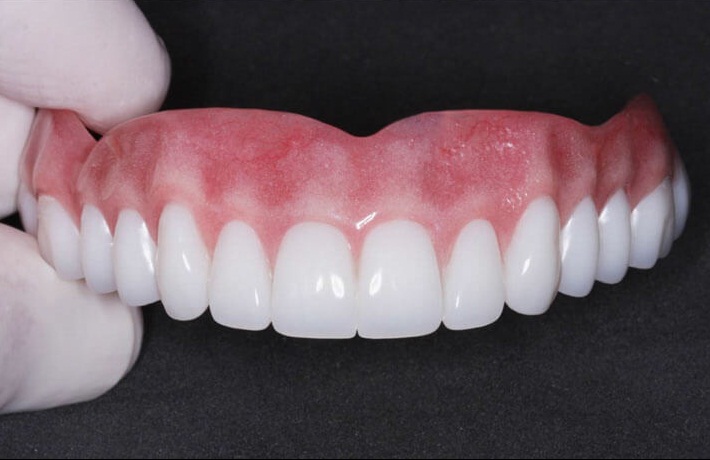 Современные съемные зубные протезы на верхнюю челюсть