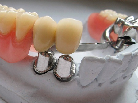 Зубные протезы бюгельные