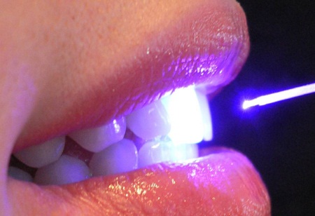 Лазерное лечение зубов в Москве