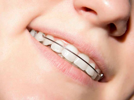 Скобы на зубы: эффективное решение по исправлению прикуса