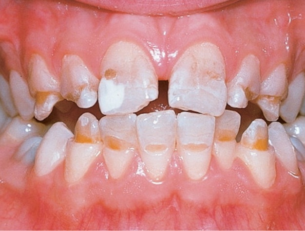 Деминерализация зубов