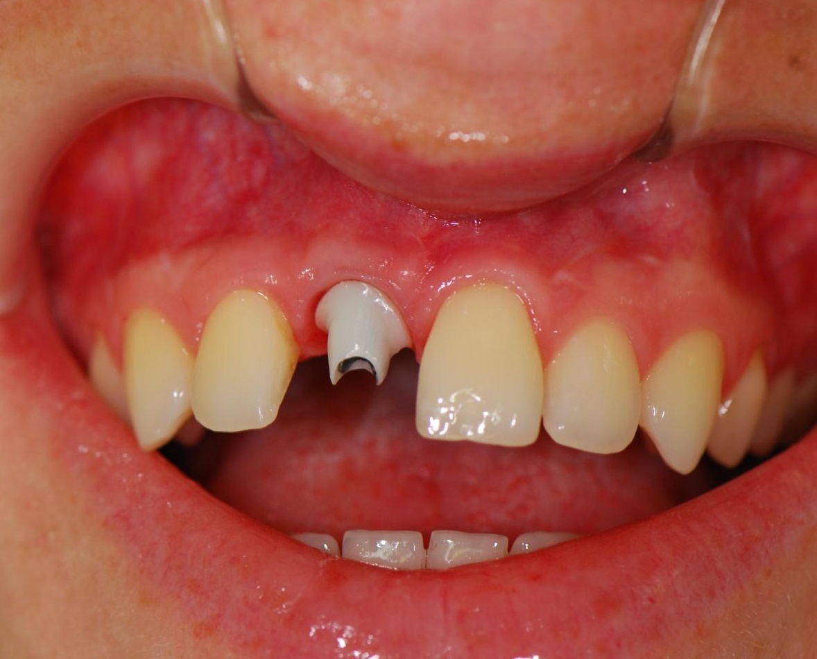 Зачем нужен временный протез после удаления зуба?